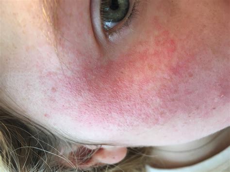 allergic to chanel makeup|allergic to makeup rash.